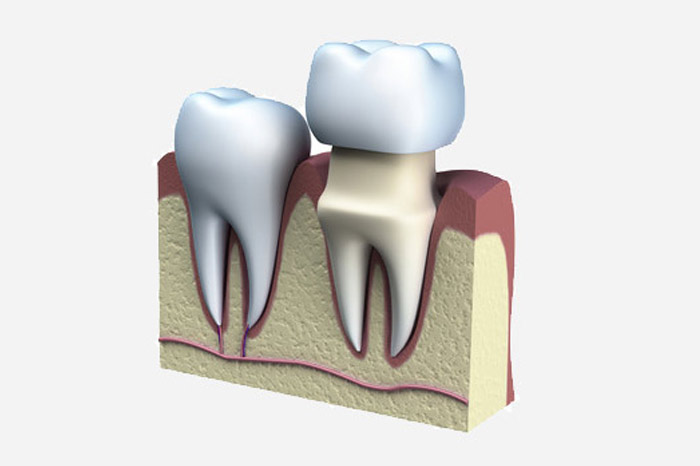 Illustration of how a dental crown works, like crowns provided by AKJ Dentistry in Lubbock.